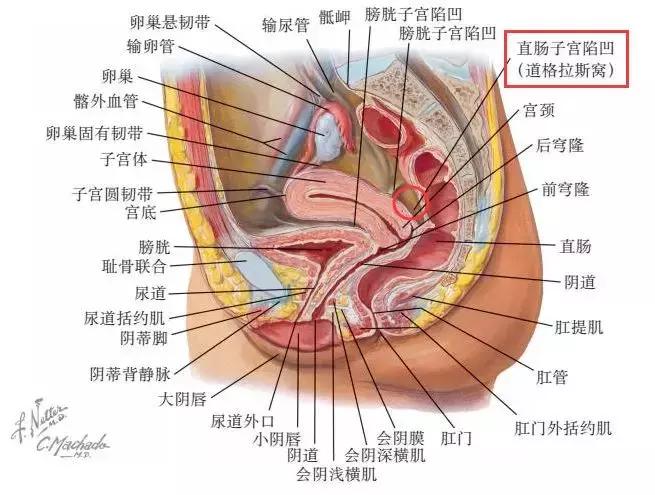 子宫直肠窝积液的原因及其影响